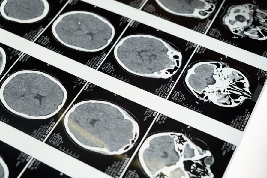 MRI images of a brain